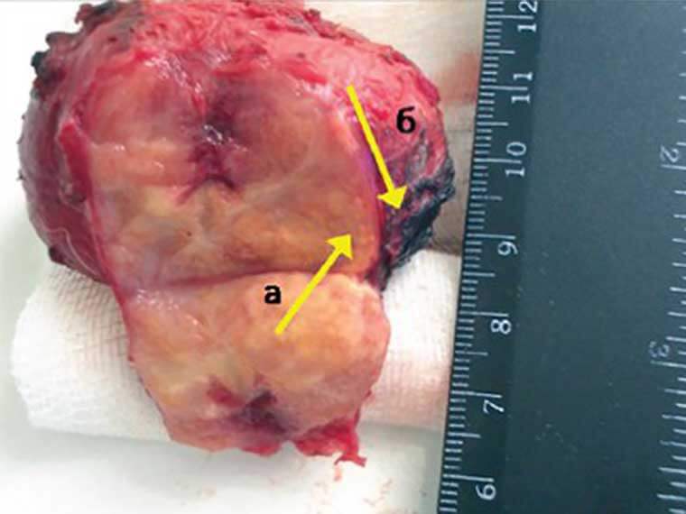 Καρκίνος προστάτη
